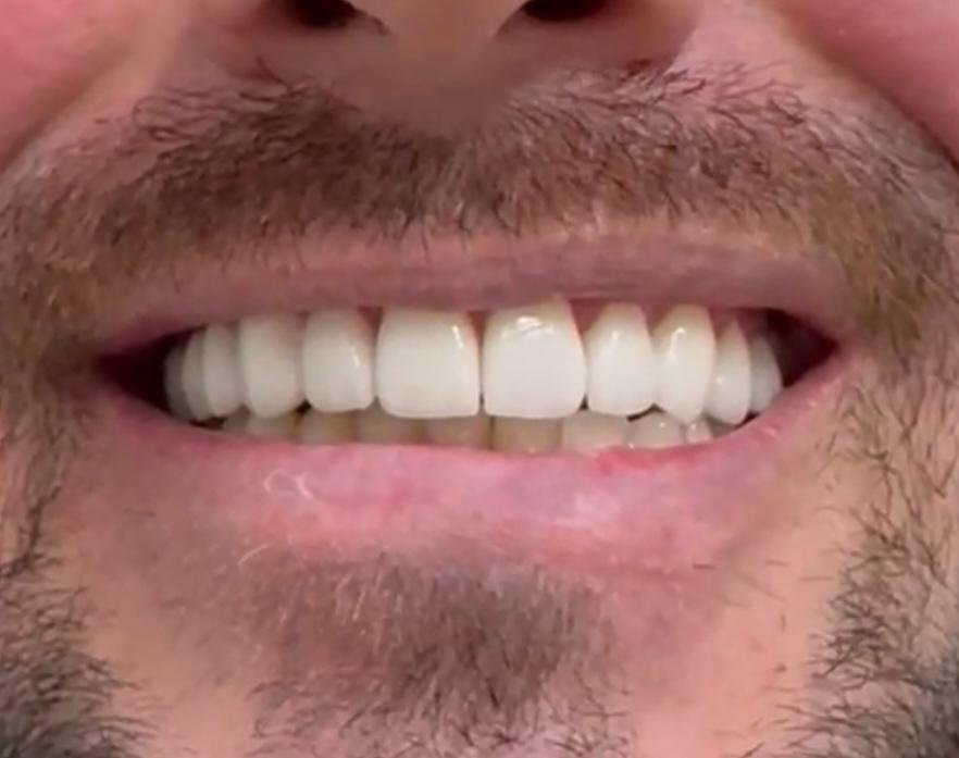 Foto do Tratamento - Facetas Dentárias