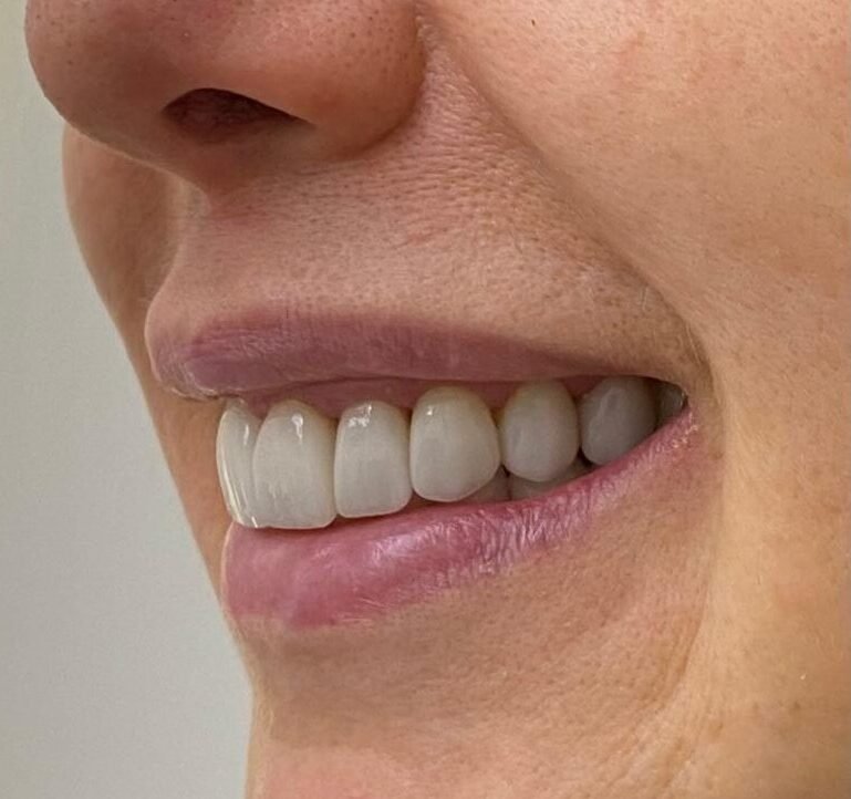 Foto do Tratamento - Facetas Dentárias